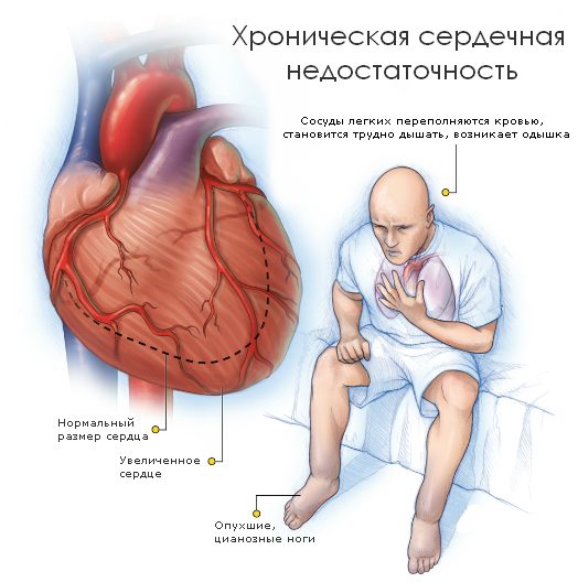 Сердечная недостаточность симптомы